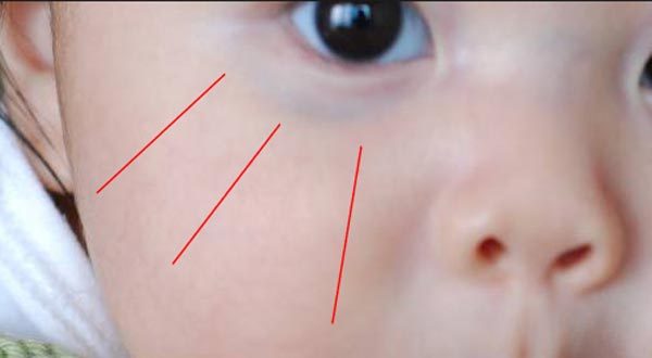 الهالات السوداء تحت العين عند الأطفال : لا تقلقي فالعلاج بسيط - طفلك